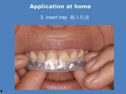 成人美白牙齿流程视频,告别黄牙困扰