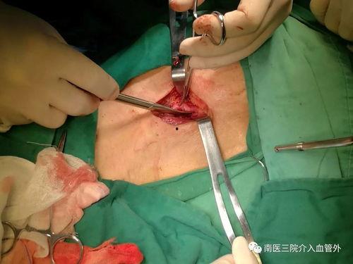 成人隐睾切除手术视频,成人隐睾切除手术全程解析与要点回顾